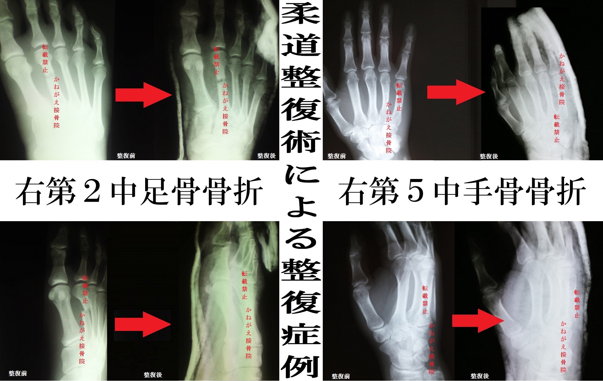 整形外科骨折徒手整復術 柔道整復 オステオパシー 整体 - jkc78.com