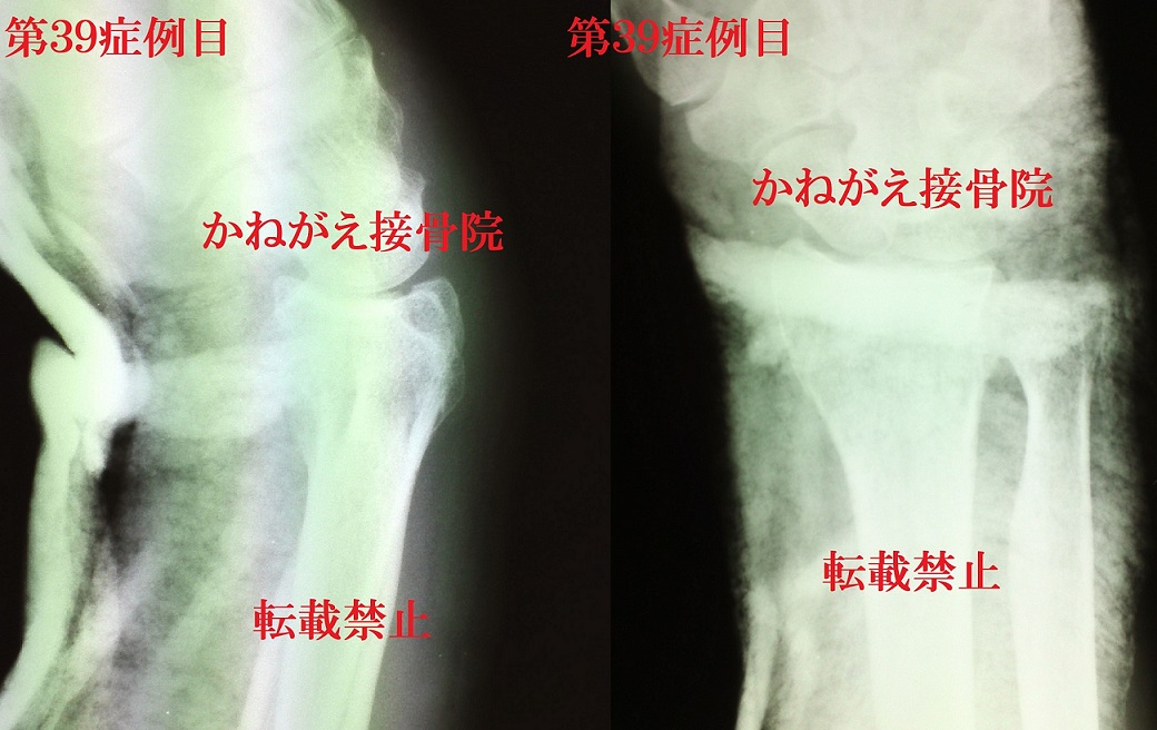 骨折の徒手整復実例集 - 健康/医学