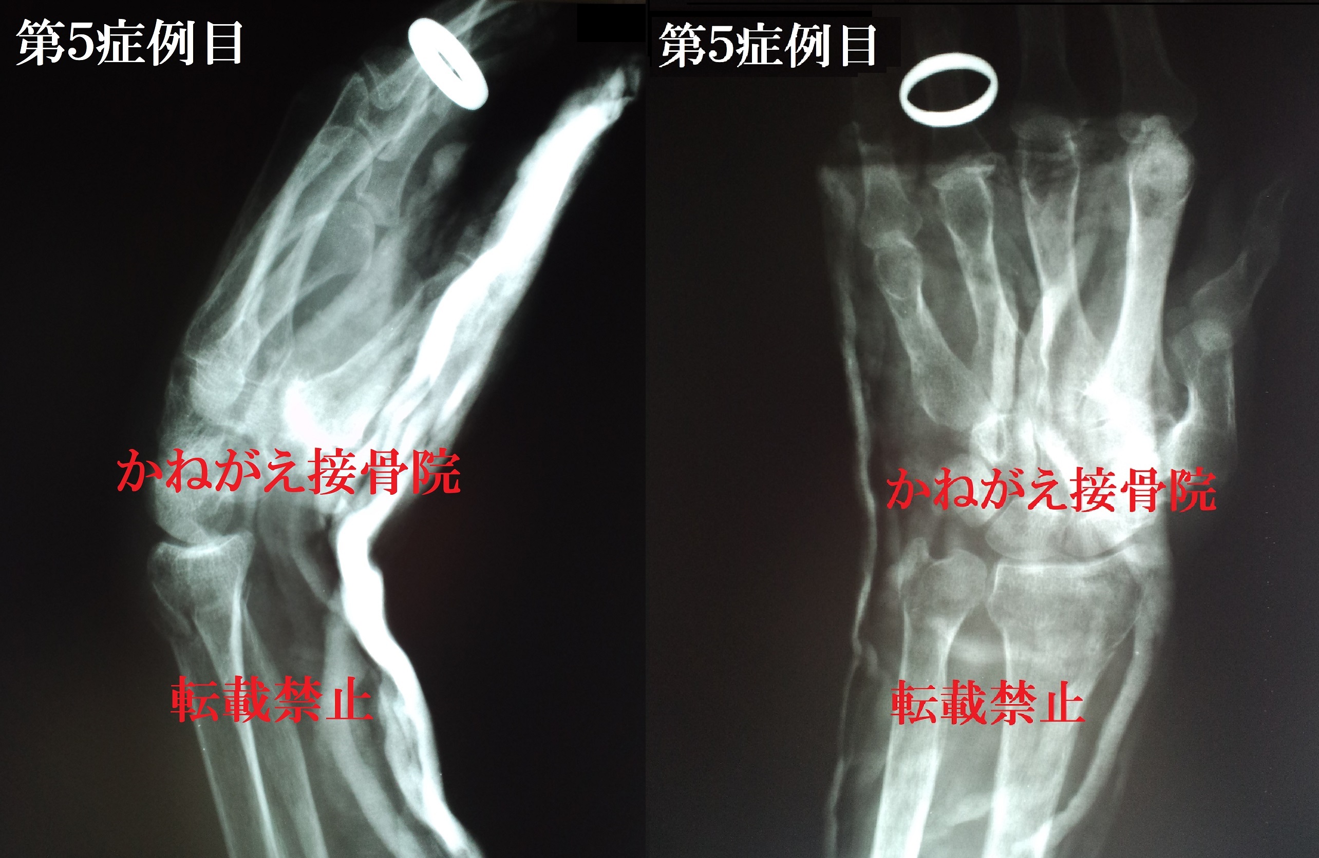 骨折の徒手整復実例集 - 健康・医学