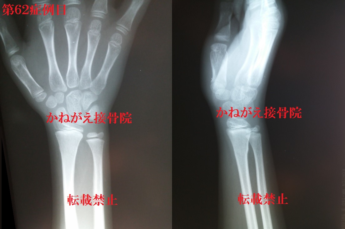 スミス骨折の徒手整復